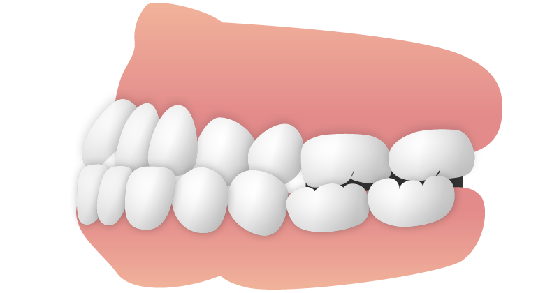 反対咬合（はんたいこうごう）