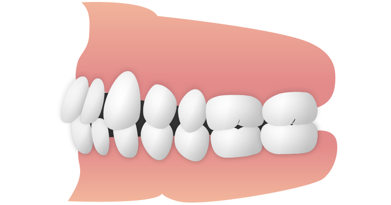 空隙歯列（くうげきしれつ）